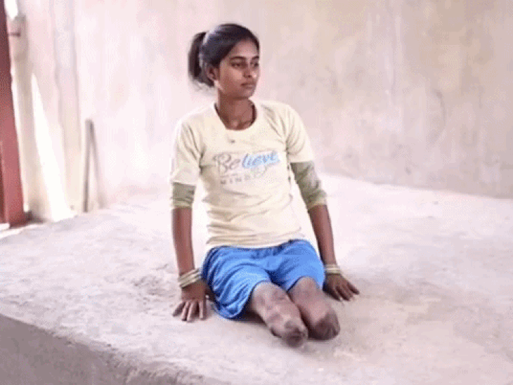 12 की उम्र में कटे दोनों पैर:14 साल बाद फिर से चलने लगी; जर्मन तकनीक से बने 3D पैर लगाए गए