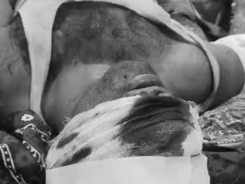 रिश्तेदारों ने युवक का नाक और कान काटे:लाठियों से पीट-पीटकर हाथ-पैर तोड़े; आवाज सुनकर पड़ोसी आए तो भाग निकले हमलावर